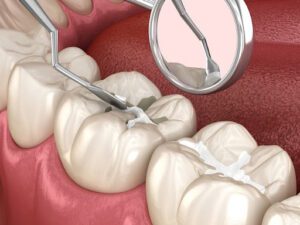 Biaya Tambal Gigi, Prosedur dan Kapan Perlu Melakukan Tambal Gigi