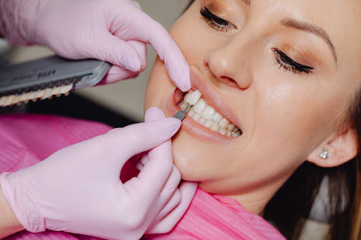 Biaya Veneer Gigi Paling Umum di Indonesia, Cek Sebelum Treatment!