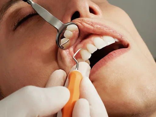 Penyakit Akibat Plak Gigi Klinik Gigi SATU Dental