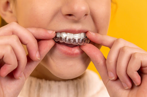 Aligner Gigi: Pengertian, Fungsi dan Perbedaannya dengan Behel 2 Perbedaan Aligner Gigi dengan Behel Gigi