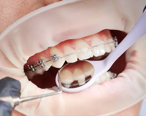 Rekomendasi Klinik Gigi untuk Pasang Behel Gigi Klinik Gigi SATU Dental