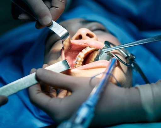 10 Perawatan Pasca Operasi Gigi Bungsu