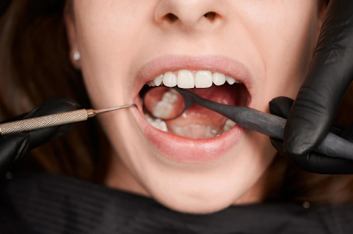Biaya Operasi Gigi Bungsu di Klinik Gigi dan Rumah Sakit
