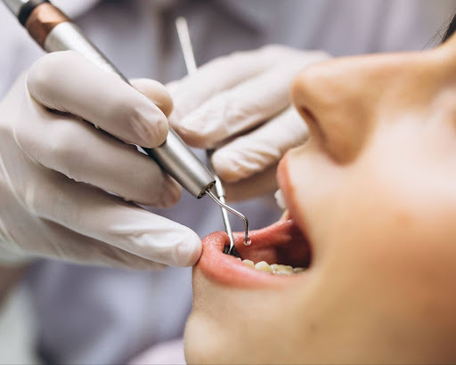 Perawatan Saluran Akar Saraf Gigi: Pengertian Sampai Perawatan