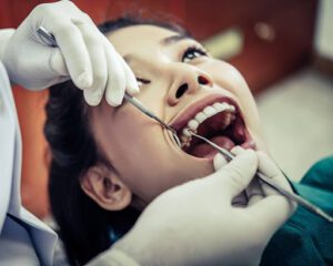 Polip Pulpa Gigi: Pengertian, Penyebab, Gejala dan Perawatan