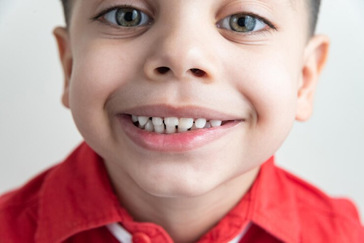10 Penyebab Gigi Anak Keropos dan Cara Mencegahnya