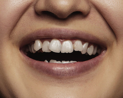 Gigi Gingsul: Gejala, Penyebab dan Cara Mengatasi yang Tepat