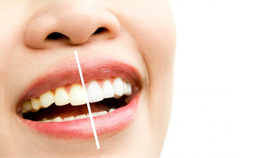 3 Cara Memutihkan Gigi, Dijamin Makin Percaya Diri