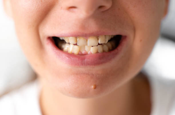 Maloklusi atau Gigi Berantakan: Penyebab dan Cara Mengatasinya