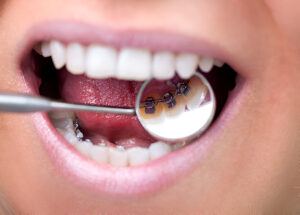 Lingual Braces Jenis dan Kelebihannya