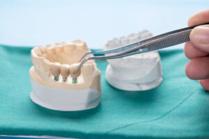 Dental Bridge: Biaya, Jenis, Manfaat dan Prosedur