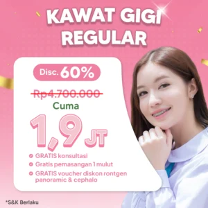 Promo Kawat Gigi Reguler 1,9jt