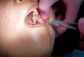 5. Fibroma