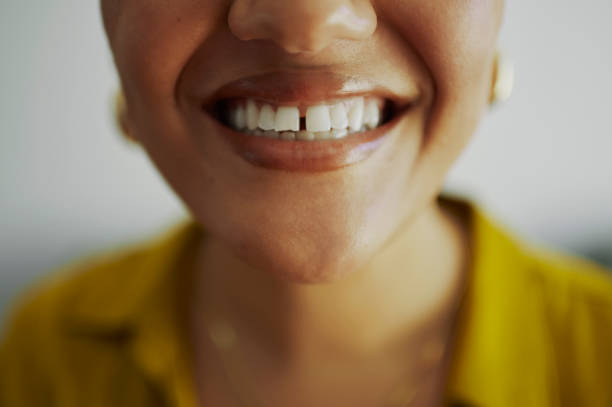 diastema gigi