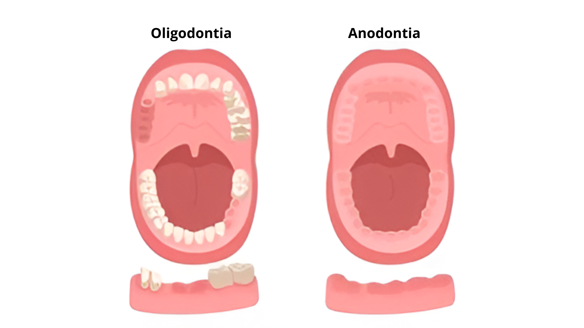 Apa itu Anodontia