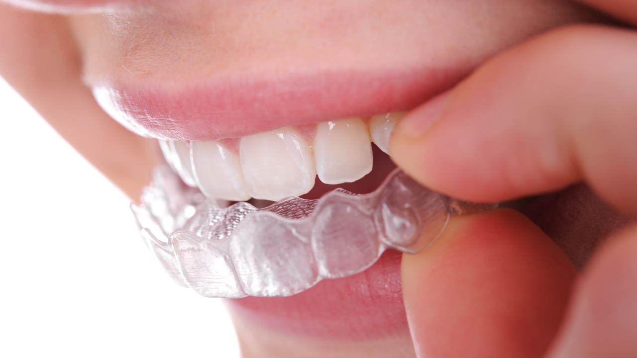 Jenis Retainer Gigi, Permanen dan Removable