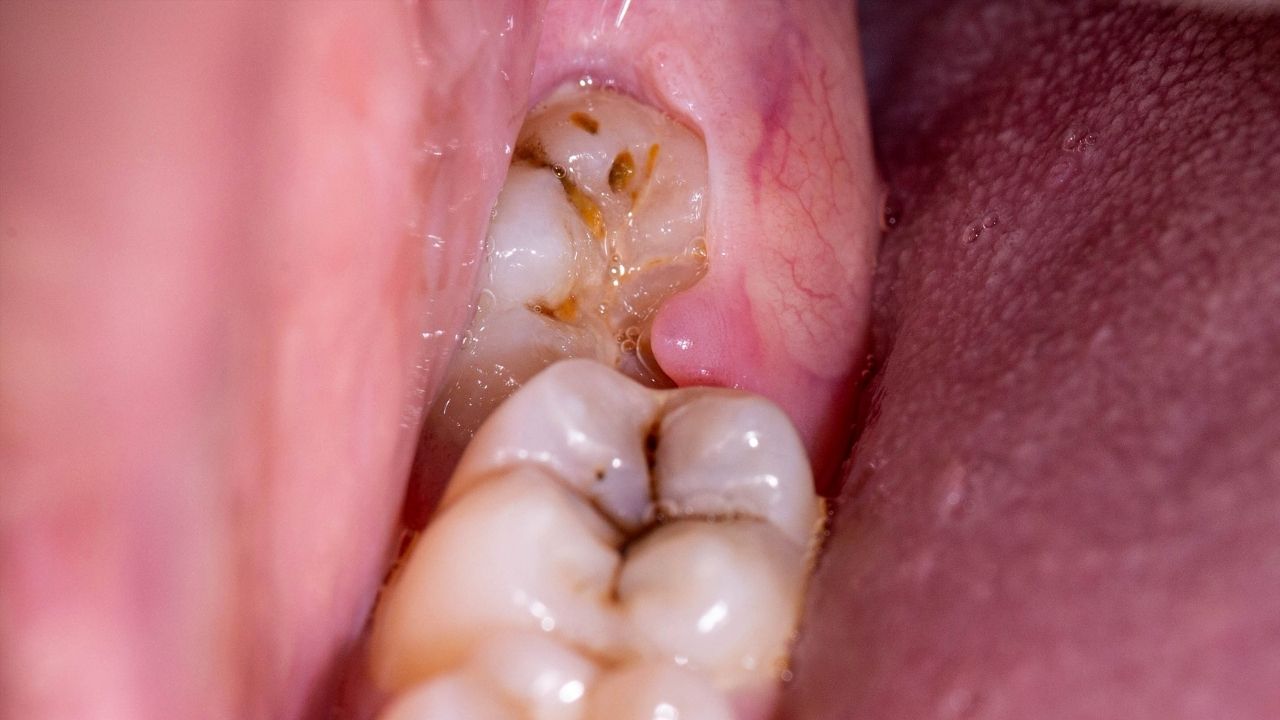 Perikoronitis: Gejala, Penyebab dan Cara Mengatasinya
