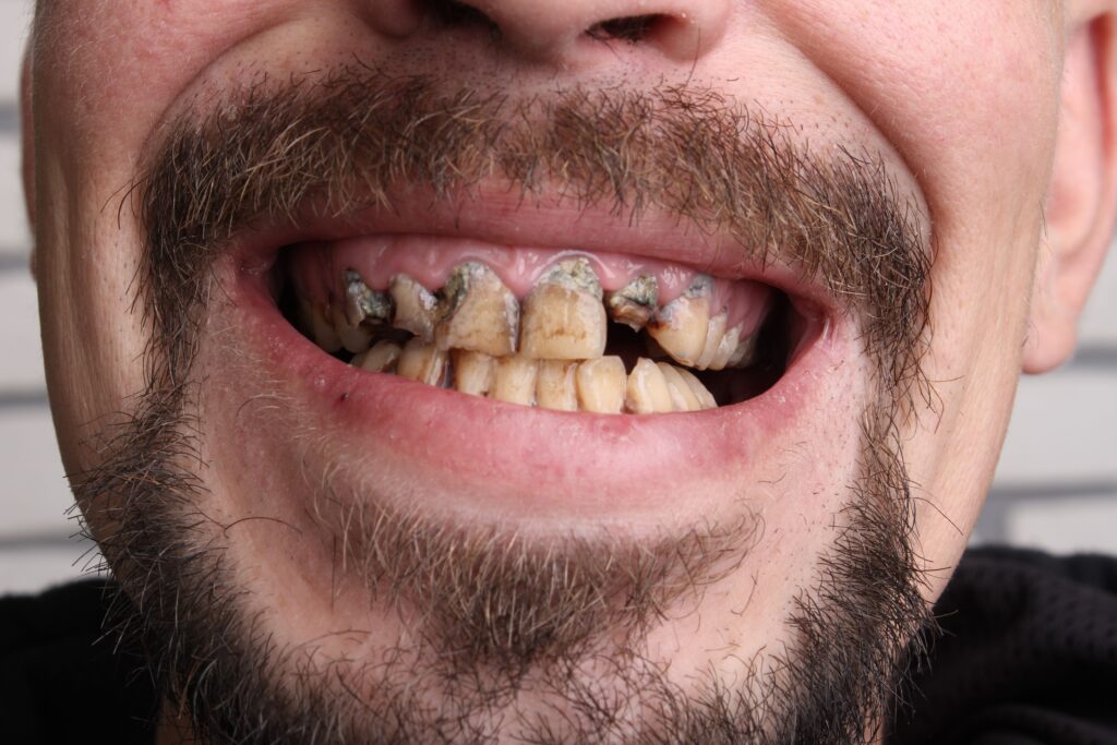 Meth Mouth: Penyebab, Gejala, dan Cara Mengobati