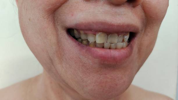 Bruxism dan Kebiasaan Oral Traumatis