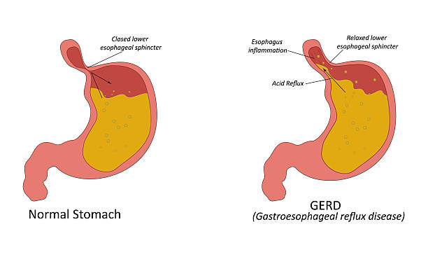 Gangguan Lambung seperti GERD atau Dispepsia
