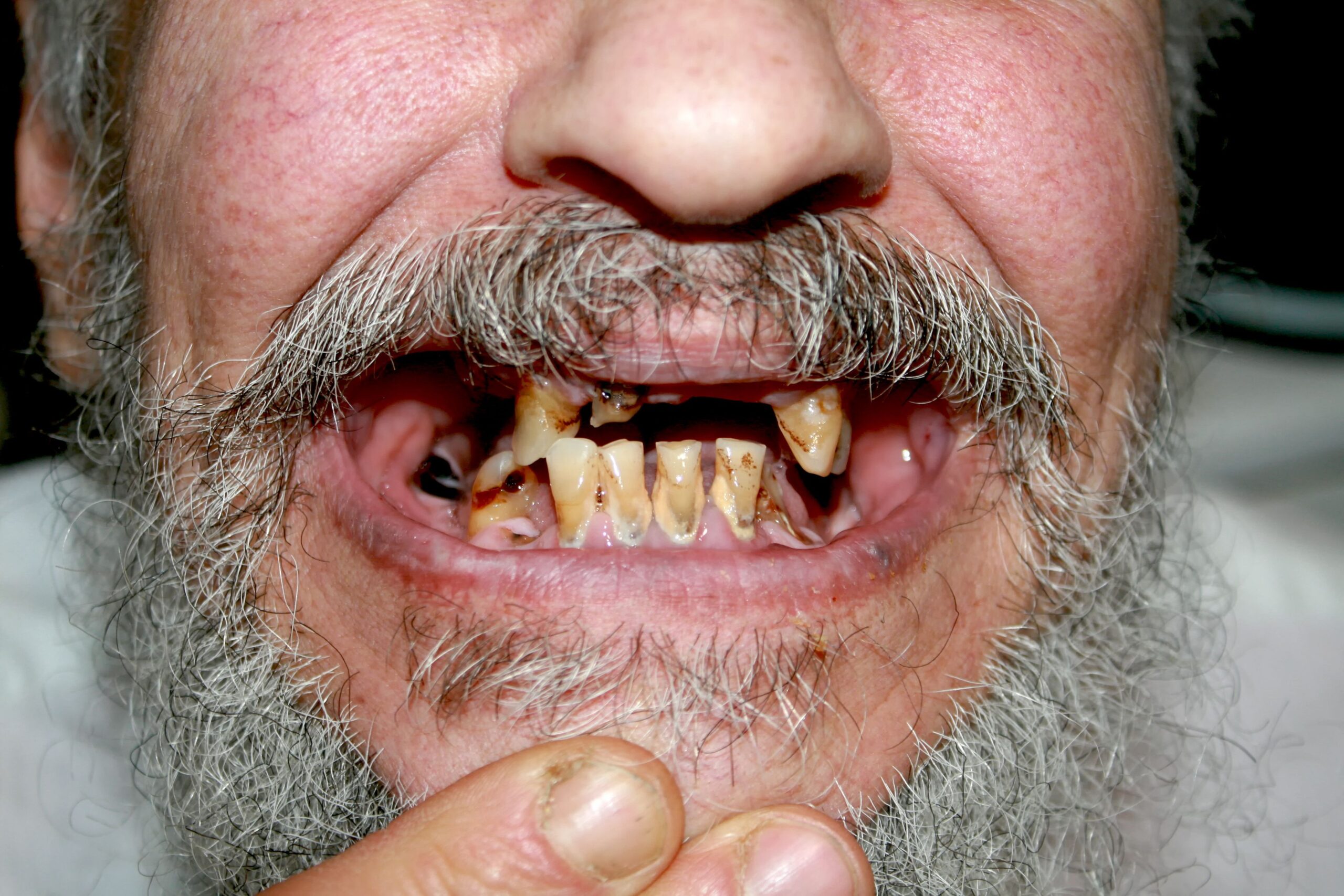 Apa Itu Meth Mouth