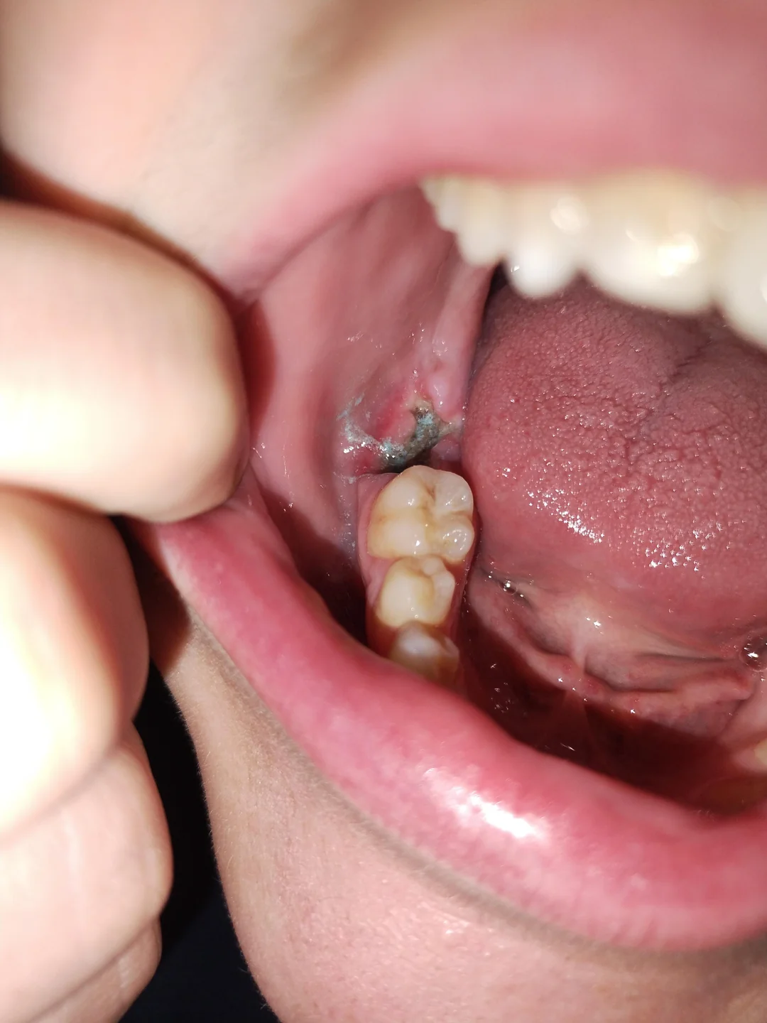 Dry Socket: Gejala dan Pencegahannya