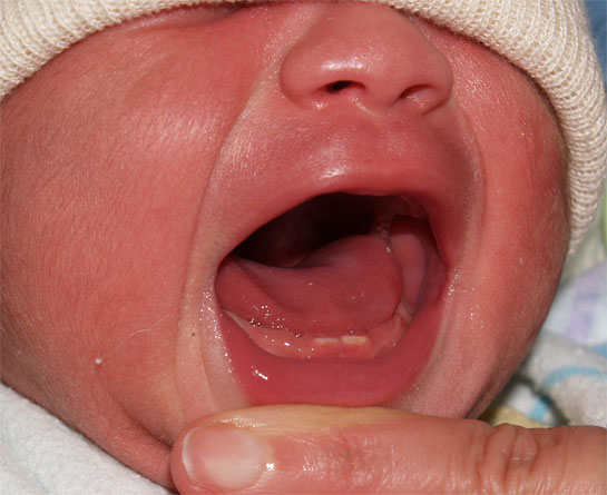 Apa Itu Natal Teeth?