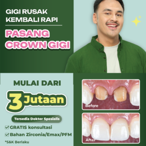 Promo Crown Gigi Mulai dari 3jtan