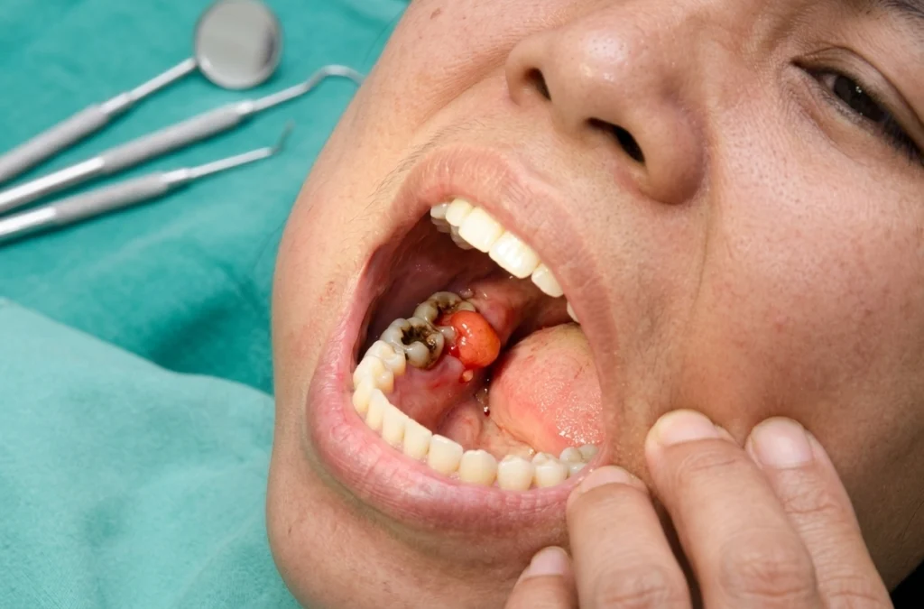 Pulpitis Adalah: Pengertian, Penyebab, dan Cara Pengobatan