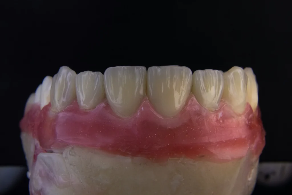Apa Itu Gigi Palsu Thermosen Klinik Gigi SATU Dental