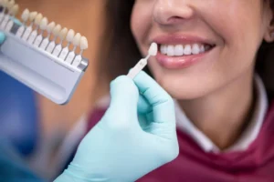 Veneer Gigi Renggang, Solusi Senyum Menjadi Rapat & Cantik!