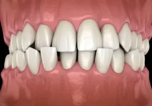 Anterior Crossbite, Jenis Gigitan Silang yang Anda Perlu Ketahui!
