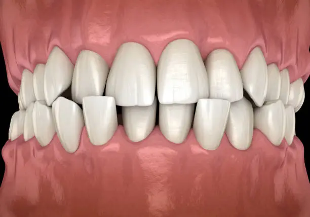 Anterior Crossbite, Jenis Gigitan Silang yang Anda Perlu Ketahui!