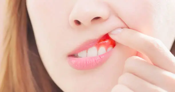 Acute Gingivitis Adalah: Sebab, Gejala & Obat Radang Gusi