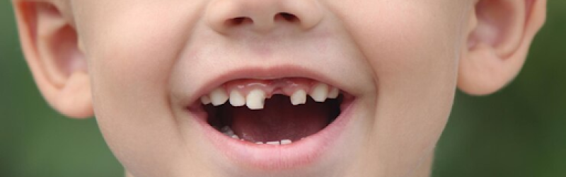 6 Cara Mengatasi Gigi Ompong dan Mencegahnya