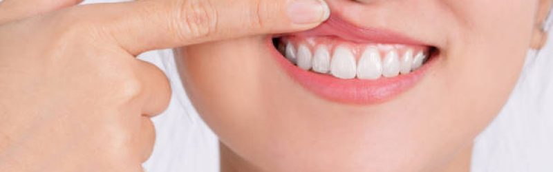 6 Penyebab Benjolan di Gusi dan Cara Mengatasinya