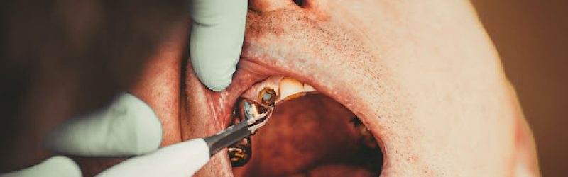 6 Penyebab Gigi Keropos dan Cara Mengatasinya
