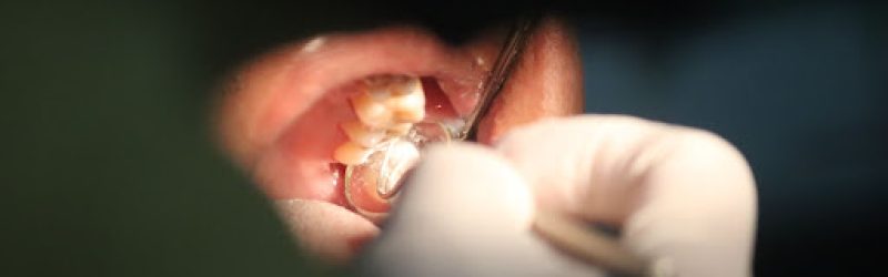 7 Cara Menghilangkan Bau Mulut Karena Gigi Berlubang
