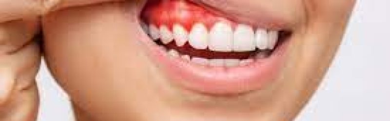 7 Penyebab Gusi Berdarah Saat Sikat Gigi dan Tips Mencegahnya