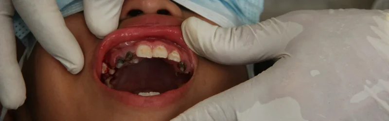 Akar Gigi Susu Tertinggal? Ini Dia yang Orang Tua Perlu Tau!