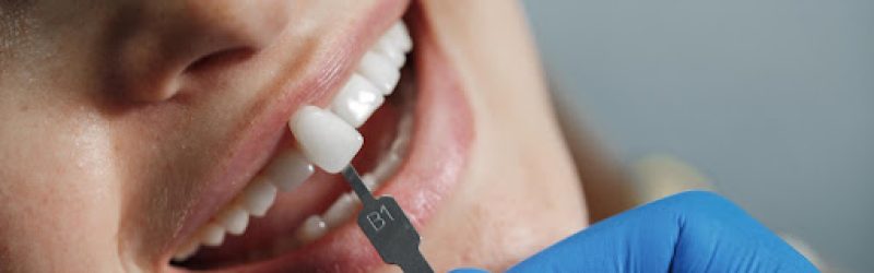 Apa Itu Veneer Gigi? Jenis dan Prosedur Pemasangan