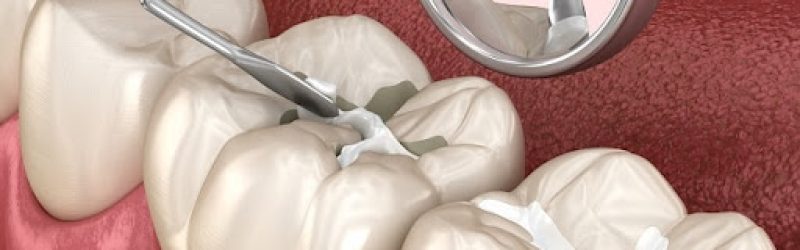 Biaya Tambal Gigi, Prosedur dan Kapan Perlu Melakukan Tambal Gigi