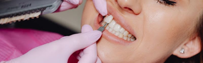 Biaya Veneer Gigi Paling Umum di Indonesia, Cek Sebelum Treatment!