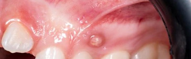 Fistula Gigi: Gejala, Peyebab, dan Penanganannya