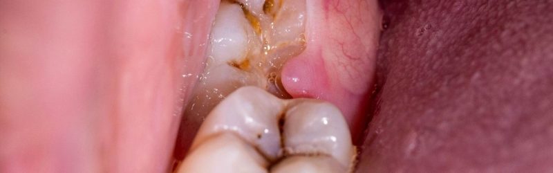 Perikoronitis: Gejala, Penyebab dan Cara Mengatasinya