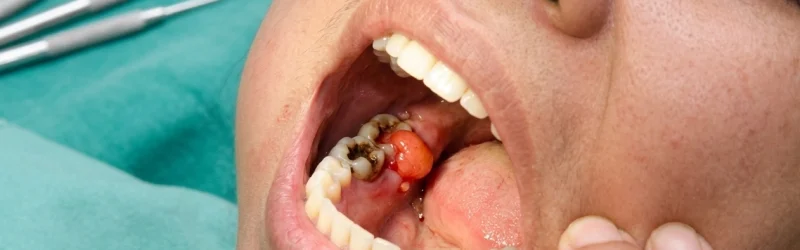 Pulpitis Adalah_ Pengertian, Penyebab, dan Cara Pengobatan