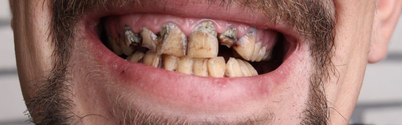 Meth Mouth: Penyebab, Gejala, dan Cara Mengobati