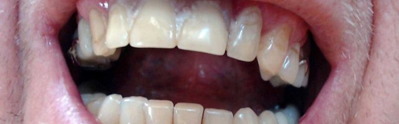 Gusi Berjamur: Cara Mengatasi, Penyebab, dan Gejalanya