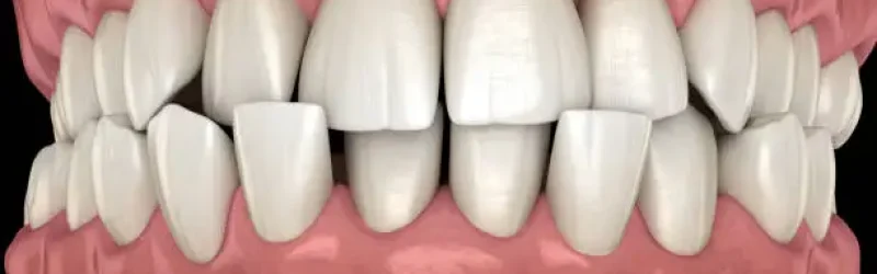 Anterior Crossbite, Jenis Gigitan Silang yang Anda Perlu Ketahui!
