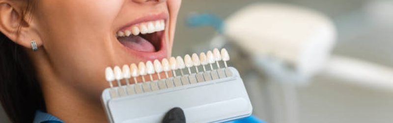 Syarat Gigi yang Boleh Veneer dan Tidak
